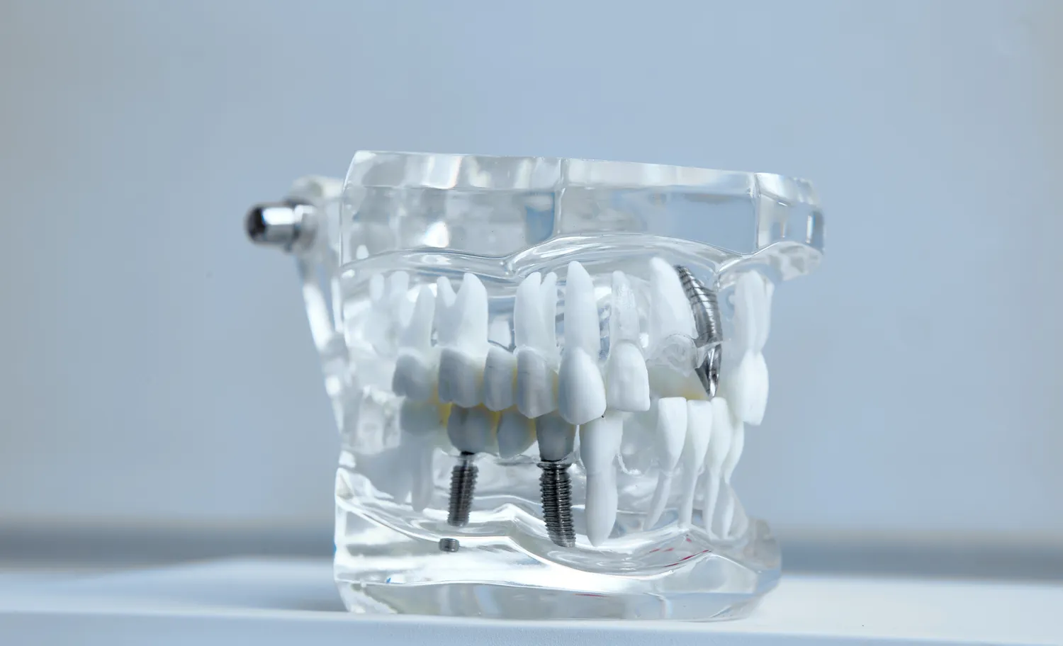 Stomatolog wykona odbudowę uzębienia przy pomocy implantów zębowych