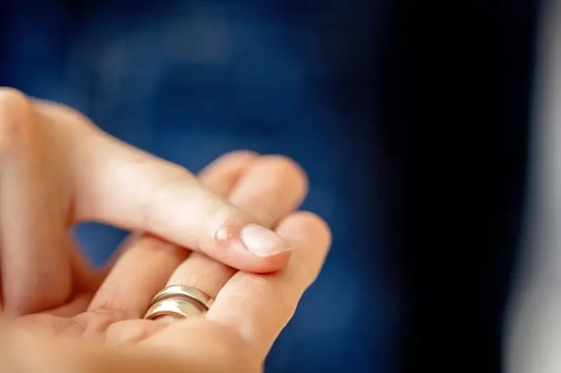 Co na kurzajki na stopie u dziecka?